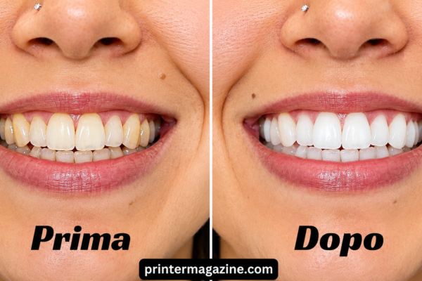 Sbiancamento Denti: Complete Guide to a Brighter and Healthier Smile